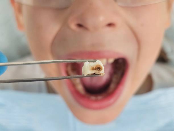Best Emergency Treatment for Dental Infections or Abscesses in Morton, IL